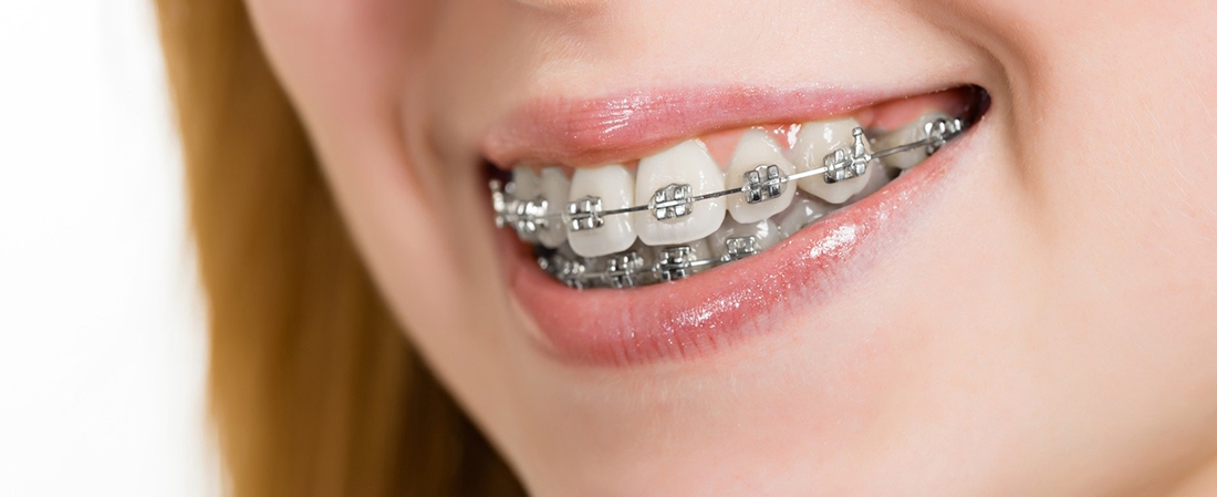 https://baysidedental.dreamhosters.com/wp-content/uploads/2017/06/components-of-braces.jpg